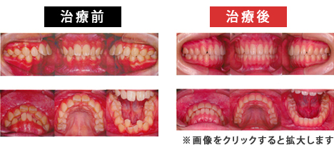 上顎前突症_叢生