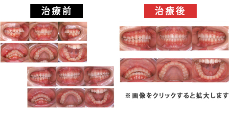 上顎前突症_叢生