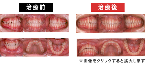 上顎前突症
