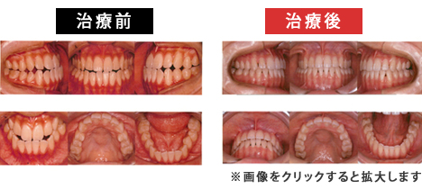下顎前突症
