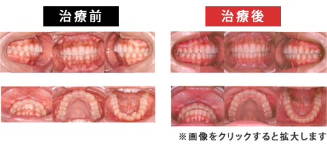 上顎前突症