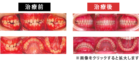 上顎前突症
