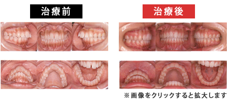 上顎前突症