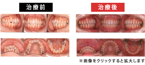 上顎前突症